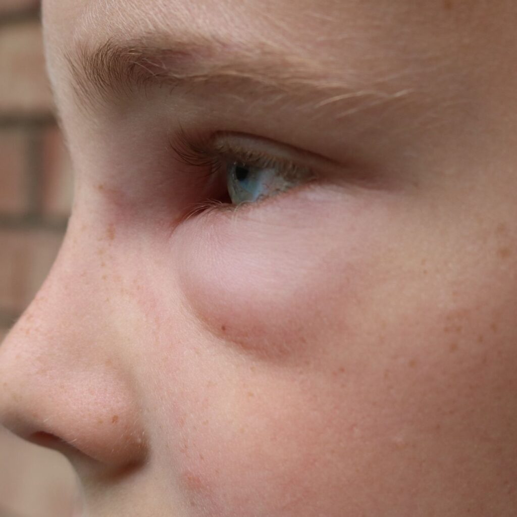 lewy profil chłopca z opuchniętą dolną powieką